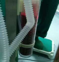 孕妇产后大出血，命悬一线终获救