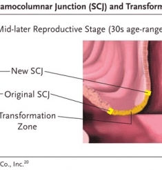 一个过时的疾病——宫颈糜烂