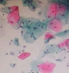 到底查TCT还是HPV？一分钟教你读懂“宫颈癌”筛查报告！