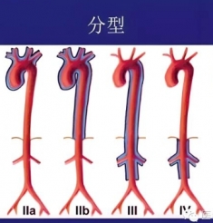 神奇的“东方美女病”，大动脉炎