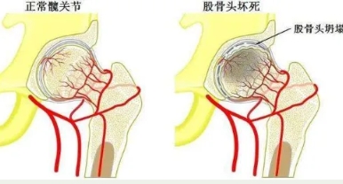 【健康科普】你真的了解股骨头坏死吗？