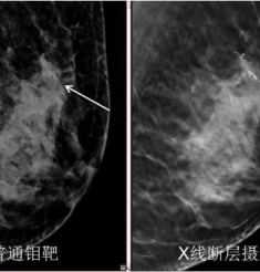 让乳腺微小病灶无处遁形 了解全数字乳腺X线摄影
