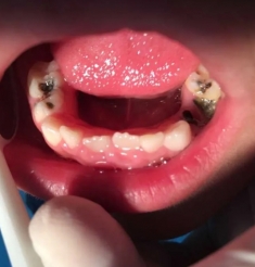 儿童乳牙龋病要尽早关注，这可能影响孩子一生