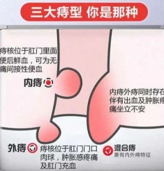 三天搞定！妈妈再也不用担心我的痔疮了