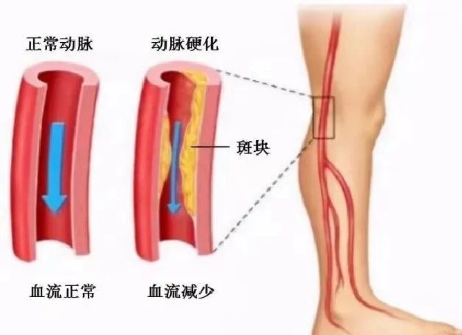 【健康科普】“腿梗”来袭？小心下肢动脉硬化闭塞症让你步履维艰
