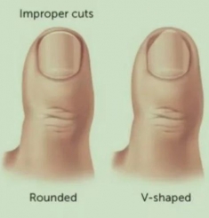 痛痛痛！小小甲沟炎你知道多少