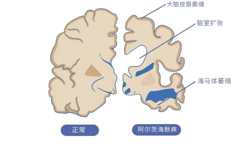 【健康科普】一次检测终身受益！载脂蛋白E（ApoE）基因分型检测，别让岁月带走记忆