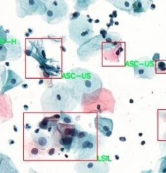 【健康科普】宫颈癌早期筛查：守护女性健康的重要防线