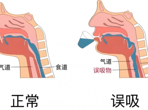 【世界吞咽日】别让“难咽之隐”拖成健康危机，早识别、早干预是关键